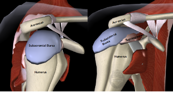 bursa removal shoulder az ízület fáj a ütés után